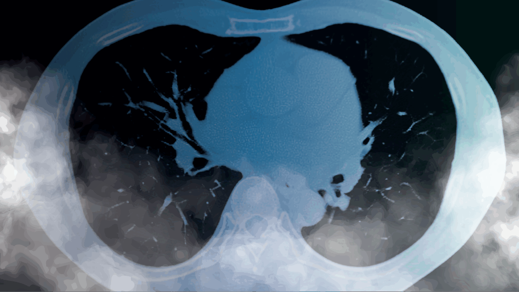 Lung X-ray with white smoke over the bottom of the image