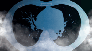 Lung X-ray with white smoke over the bottom of the image
